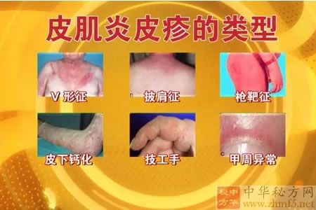 皮肌炎皮疹的类型